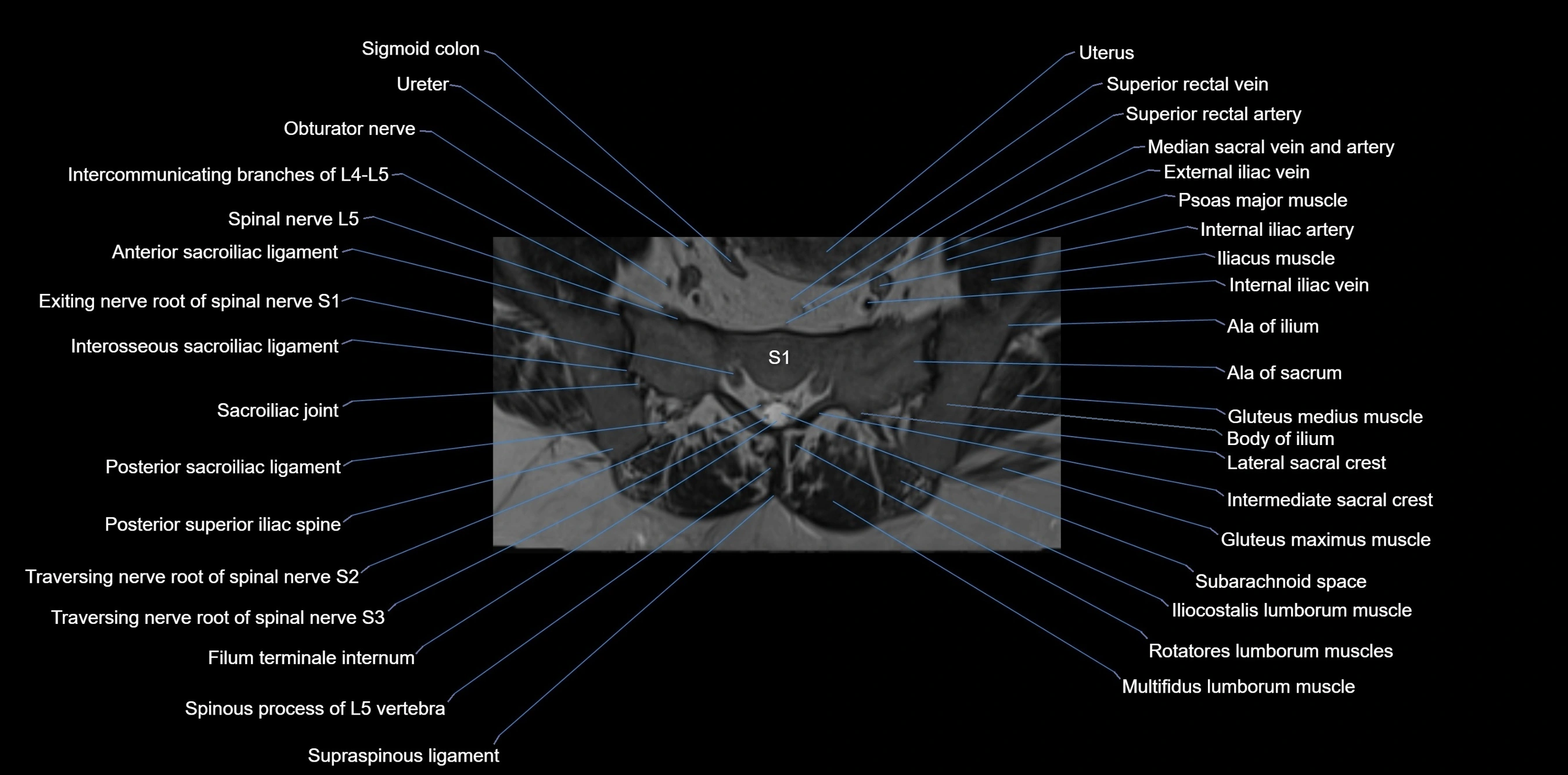 MRI sacrum, coccyx and sacroiliac joint axial cross sectional anatomy 3T  radiology  image-img-00001-00016.webp